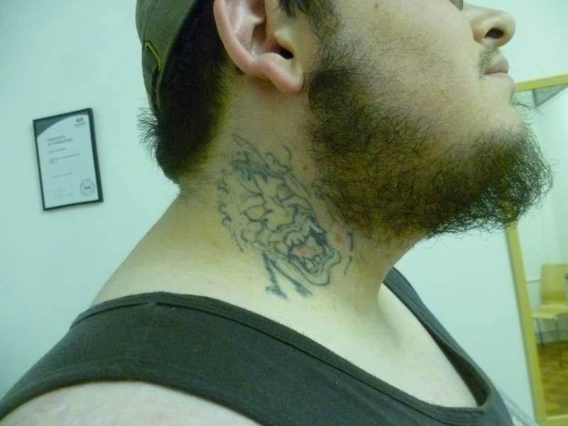 Before removal treatment began (above) and after (below). There needs to be an eight-week pause between treatments, so the lymph system can remove the broken-up ink particles. Complete removal can take two years or more. Photos: Melbourne Tattoo Removal