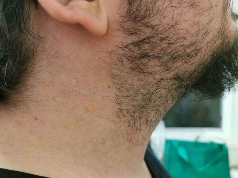 Before removal treatment began (above) and after (below). There needs to be an eight-week pause between treatments, so the lymph system can remove the broken-up ink particles. Complete removal can take two years or more. Photos: Melbourne Tattoo Removal