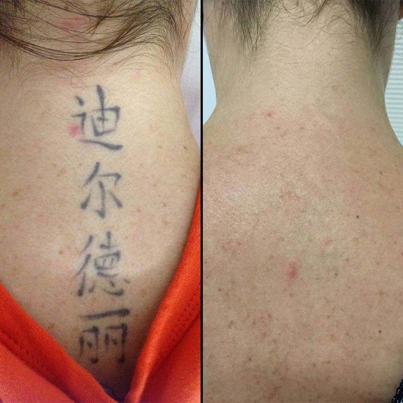 Photo: Melbourne Tattoo Removal