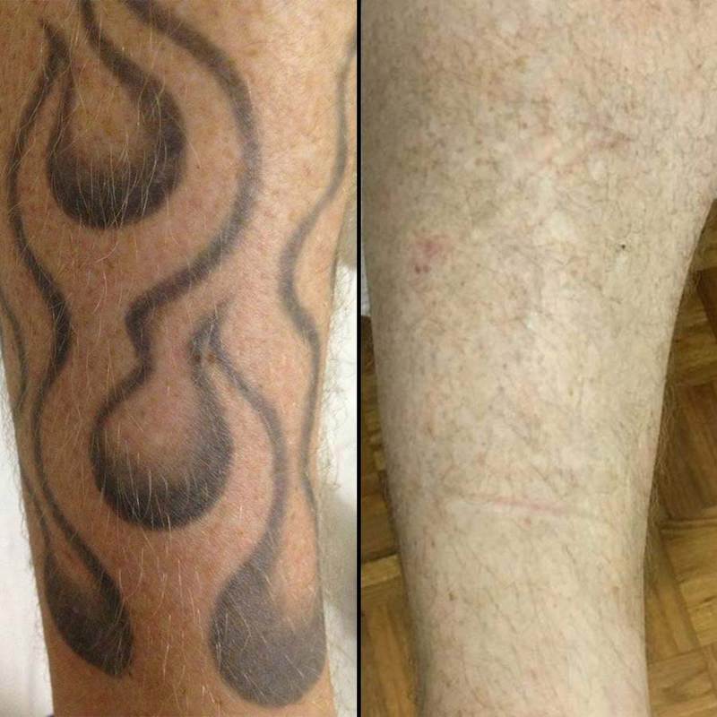 Photo: Melbourne Tattoo Removal