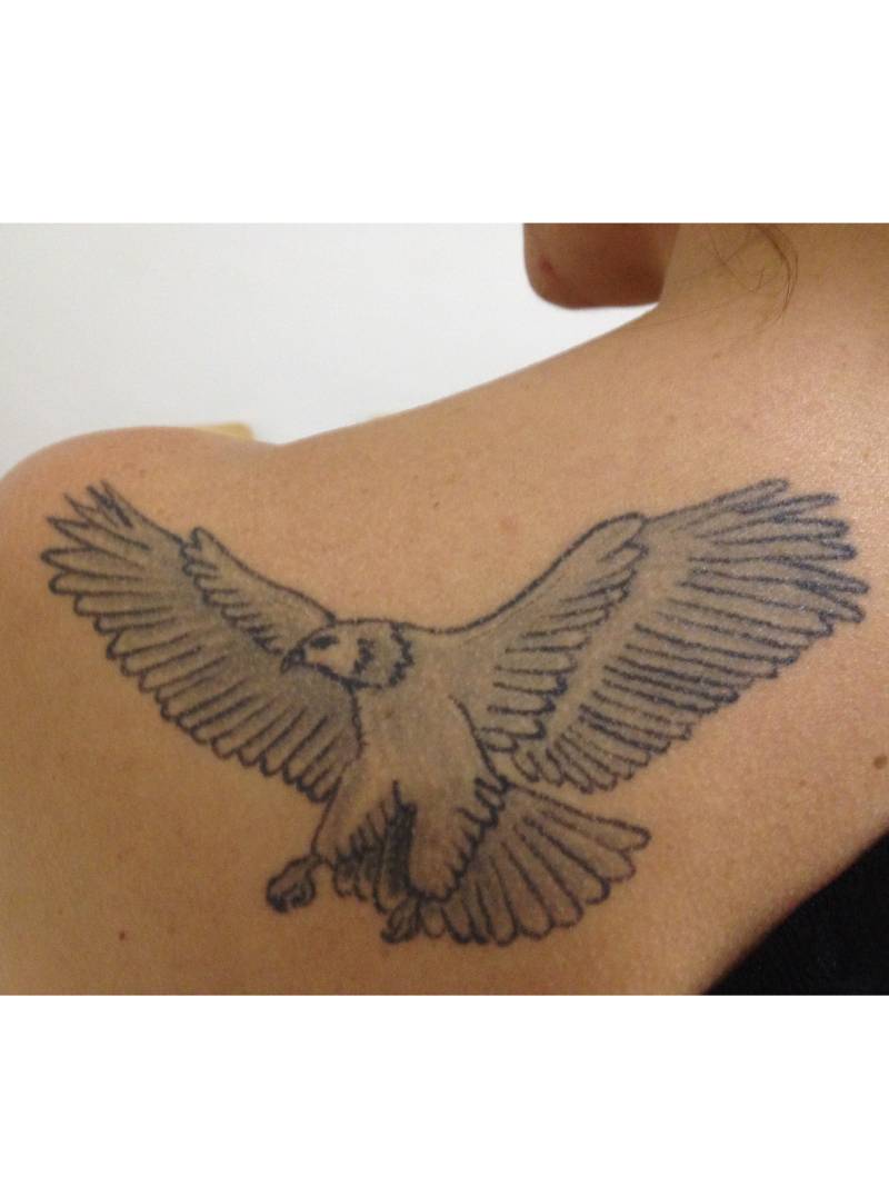 tattoo-removal-before--after-no.-22-pic-12 tattoo-removal-before--after-no.-22-pic-12