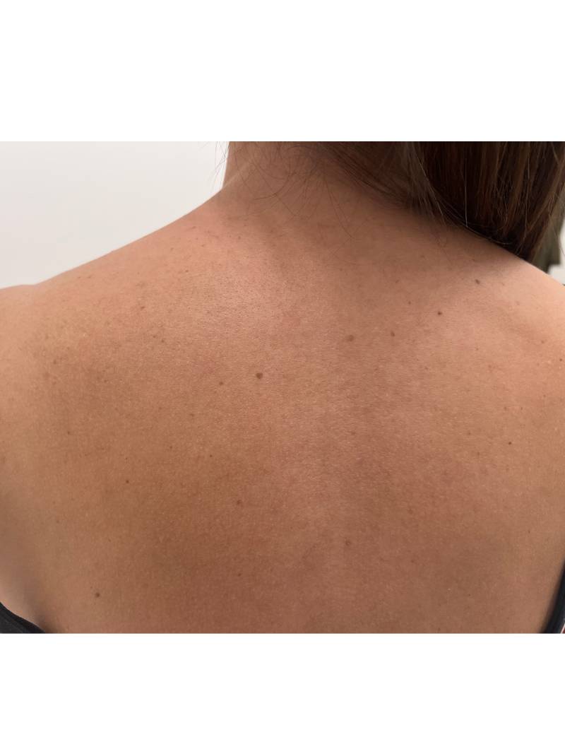 tattoo-removal-before--after-no.-22-pic-22 tattoo-removal-before--after-no.-22-pic-22