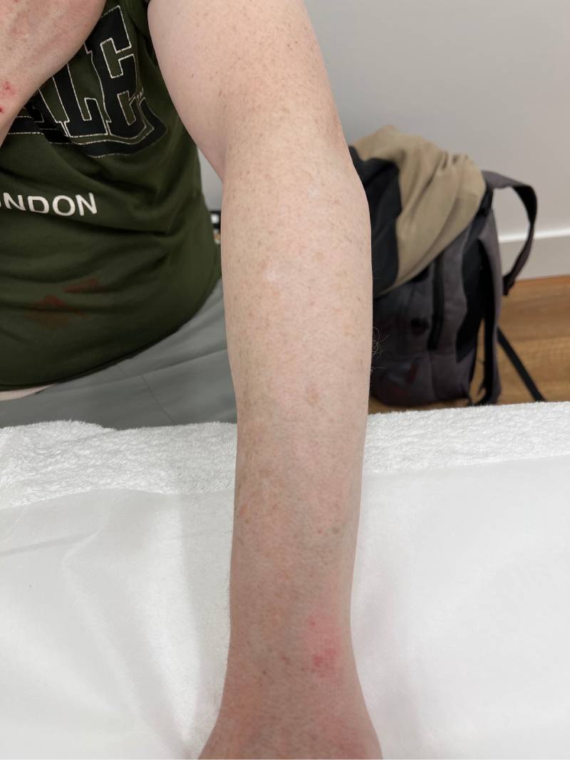 tattoo-removal-before--after-no.-23-pic-12 tattoo-removal-before--after-no.-23-pic-12