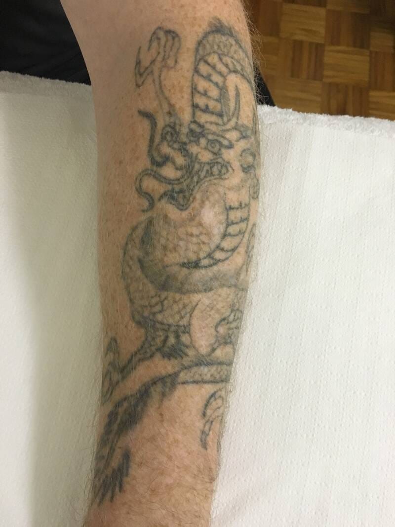 tattoo-removal-before--after-no.-23-pic-22 tattoo-removal-before--after-no.-23-pic-22