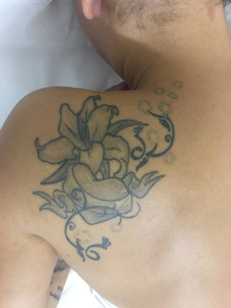 tattoo-removal-before--after-no.-24-pic-12 tattoo-removal-before--after-no.-24-pic-12