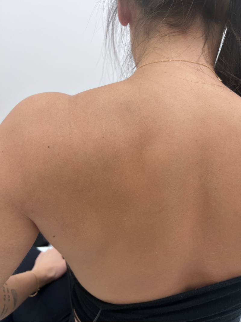 tattoo-removal-before--after-no.-24-pic-22 tattoo-removal-before--after-no.-24-pic-22