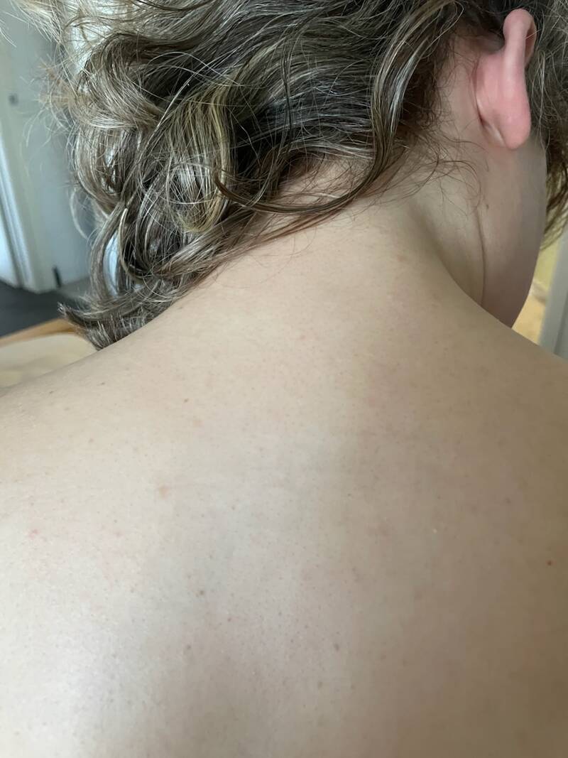 tattoo-removal-before--after-no.-26-pic-22 tattoo-removal-before--after-no.-26-pic-22