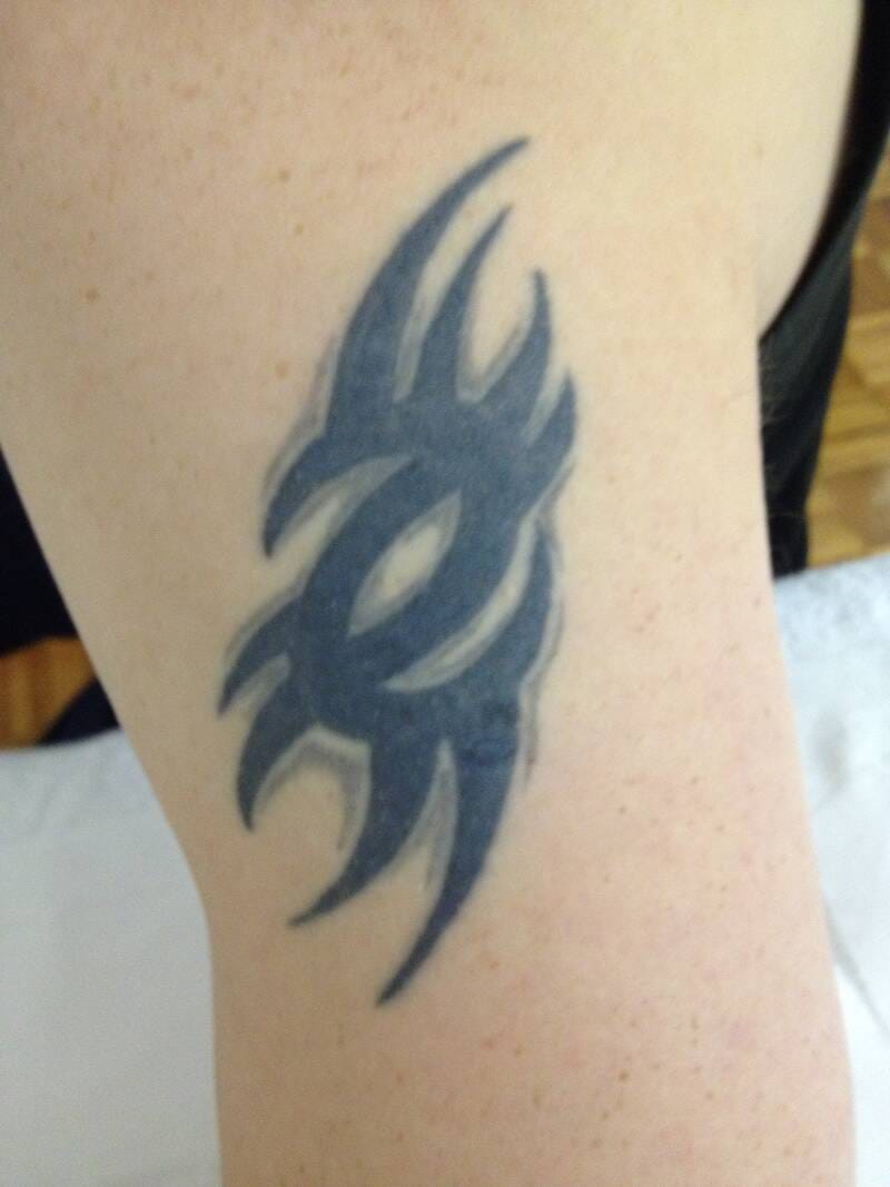 tattoo-removal-before--after-no.-27-pic-12 tattoo-removal-before--after-no.-27-pic-12