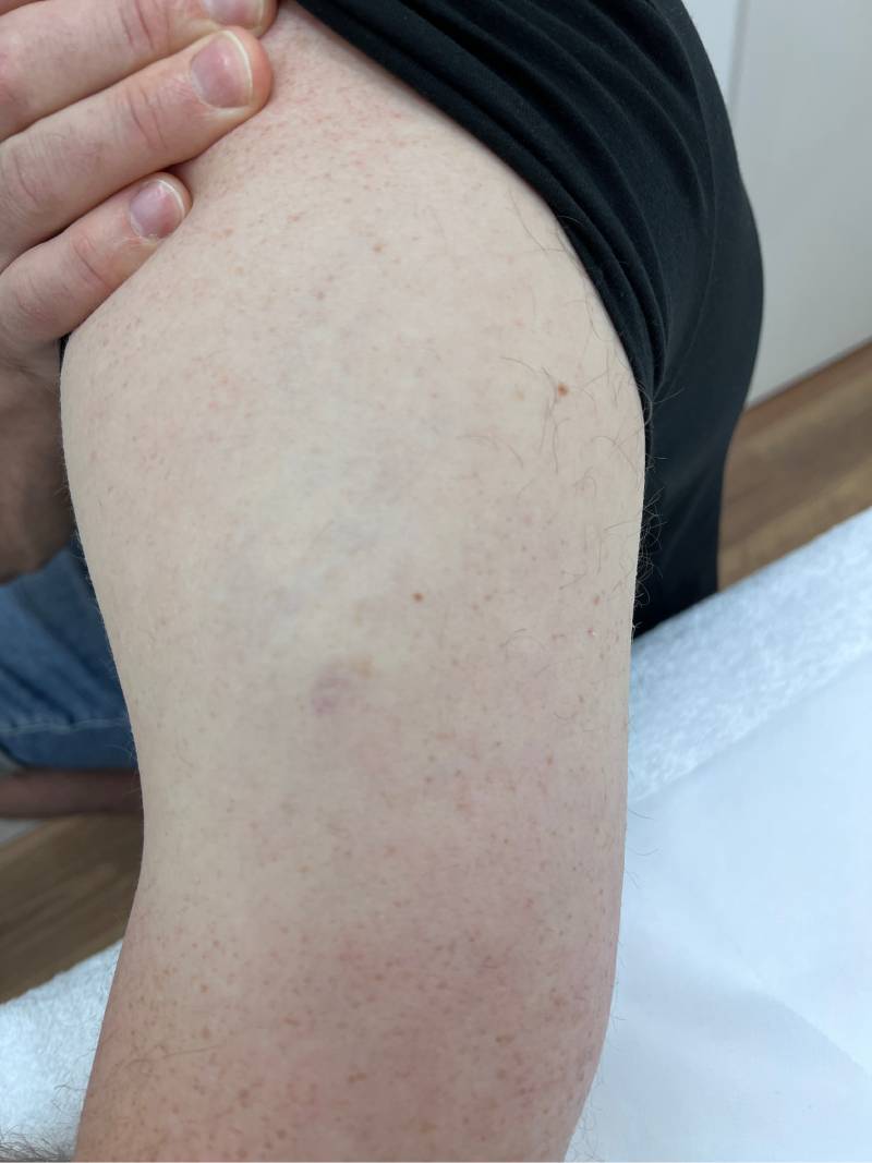 tattoo-removal-before--after-no.-27-pic-22 tattoo-removal-before--after-no.-27-pic-22