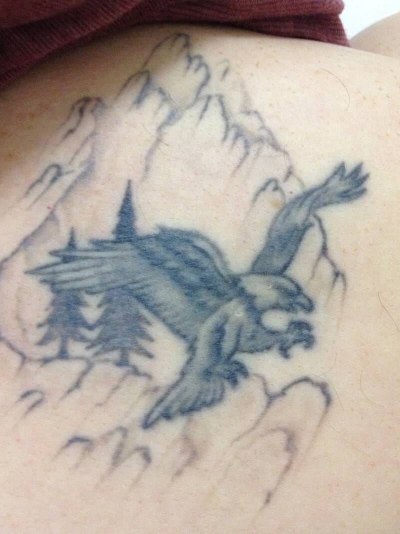 tattoo-removal-before--after-no.-28-pic-12 tattoo-removal-before--after-no.-28-pic-12