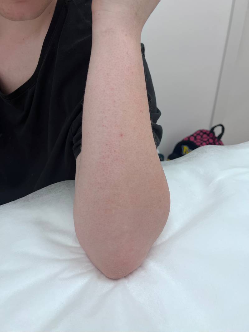 tattoo-removal-before--after-no.-29-pic-12 tattoo-removal-before--after-no.-29-pic-12