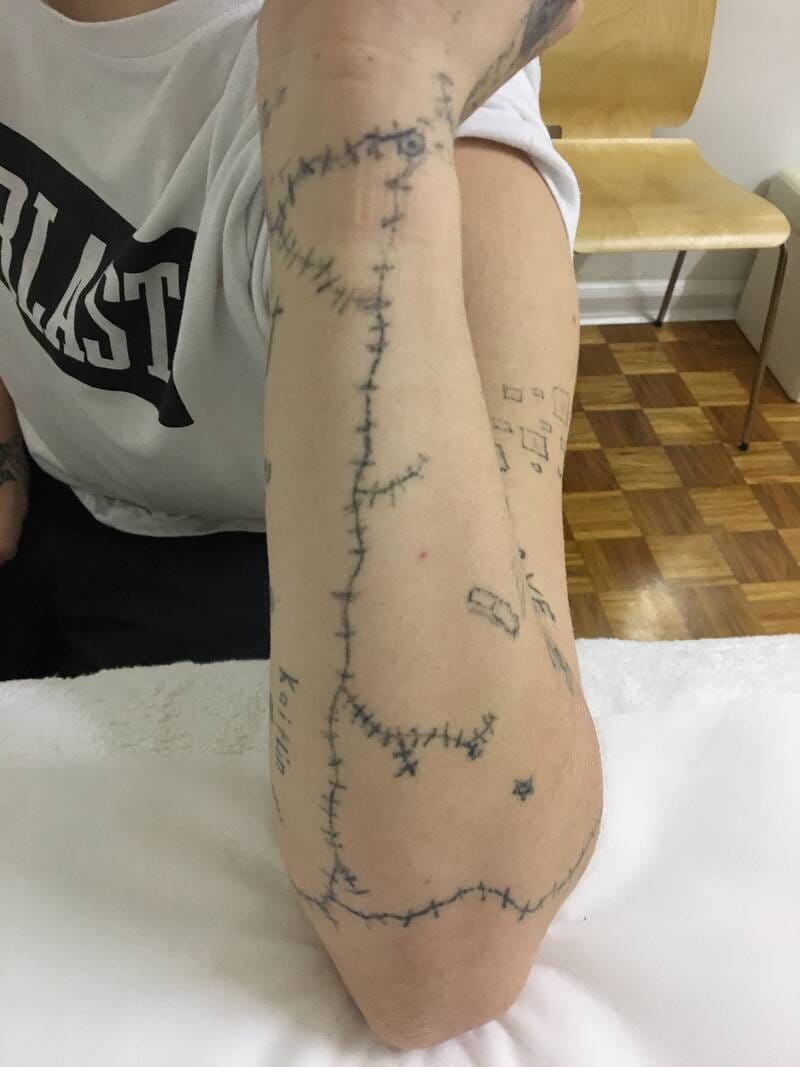 tattoo-removal-before--after-no.-29-pic-22 tattoo-removal-before--after-no.-29-pic-22